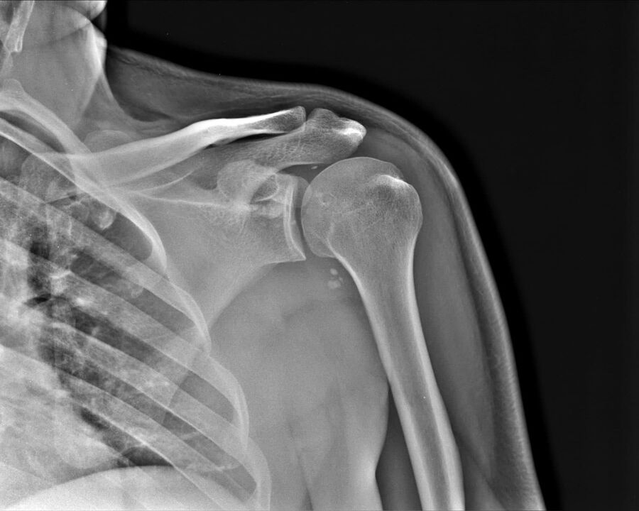 X-ray of osteoarthritis of the shoulder joint of 2nd degree of severity