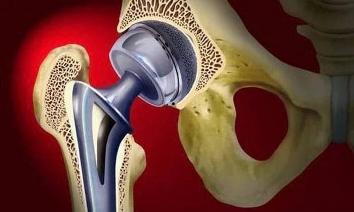 hip replacement for osteoarthritis