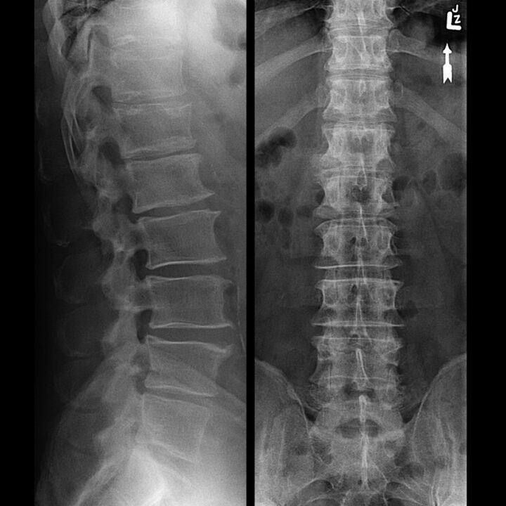 Chest X-ray showing a reduction in the gap between the vertebrae in the spine from the bottom up