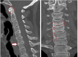 CT shows damaged vertebrae and discs of varying heights due to thoracic osteochondrosis