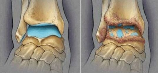 healthy joints and osteoarthritis of the ankle