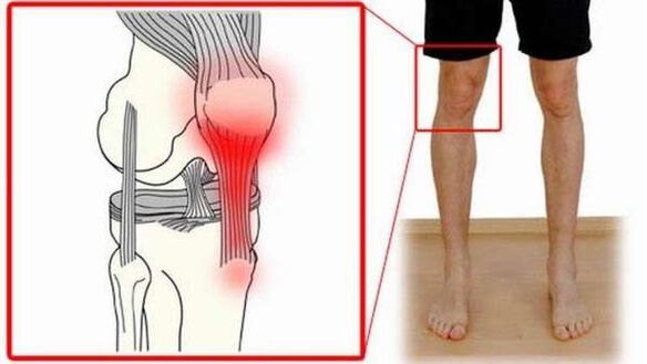 joint damage in shoulder osteoarthritis