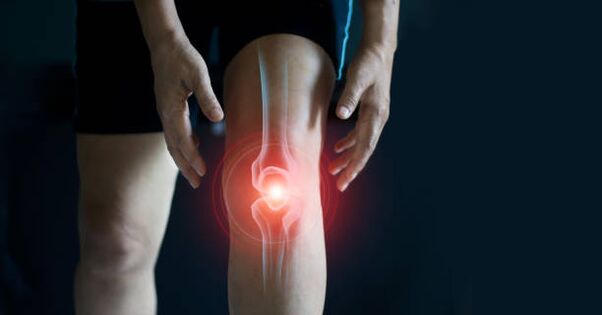 Knee arthrosis