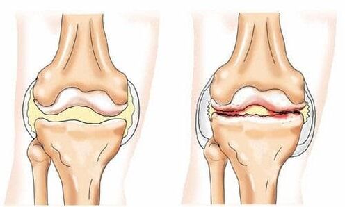 healthy and arthritic knee joint