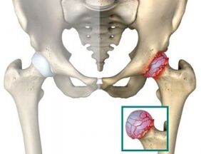 causes of osteoarthritis of the hip joint