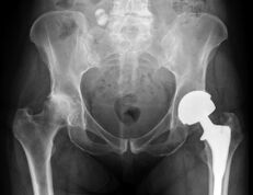 diagnosis of arthrosis of the hip joint