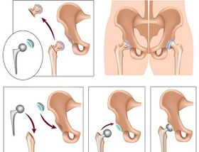 hip arthroplasty