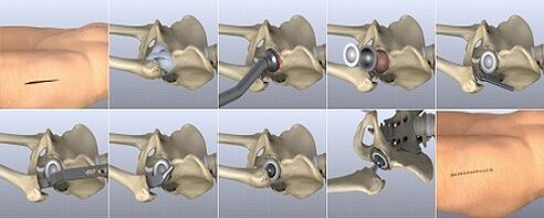 methods of treatment of arthrosis of the hip joint
