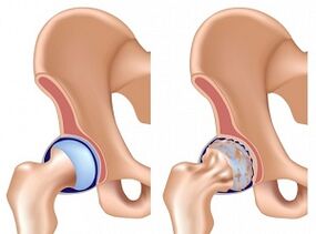 symptoms of hip arthrosis